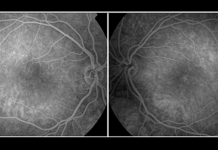 Angiofluoresceinografia (Retinografia Fluorescente)